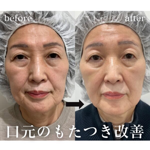 テスリフト