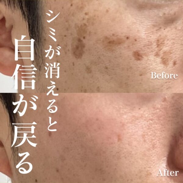 シミ治療（ピコトーニング、ピコスポット）