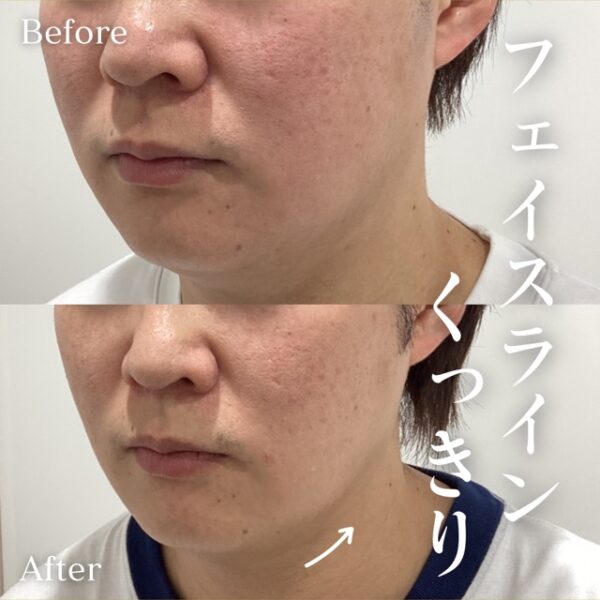 男性インモードVリフト5回目