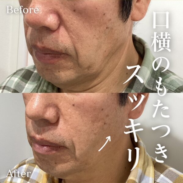 たるみ治療（ハイフ）