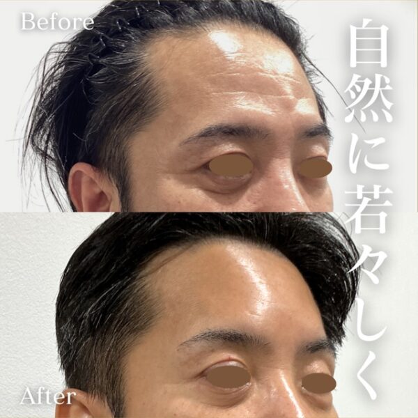 ヒアルロン酸注入（額）