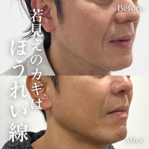 ヒアルロン酸注入（ほうれい線）