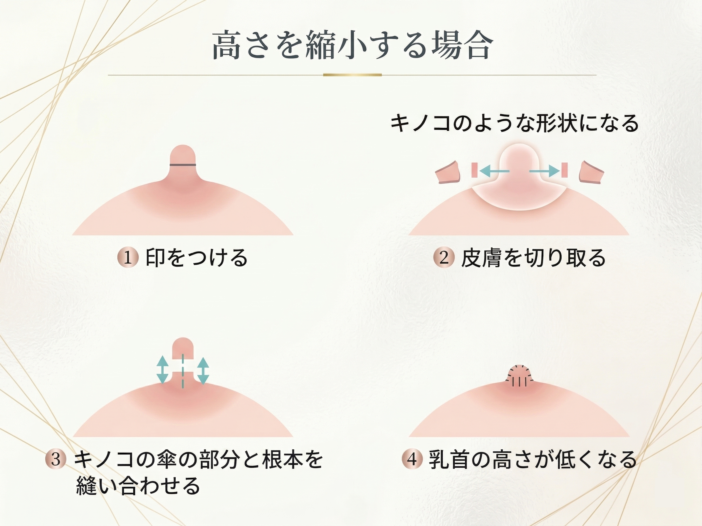 乳頭縮小(高さ)の手術方法解説図