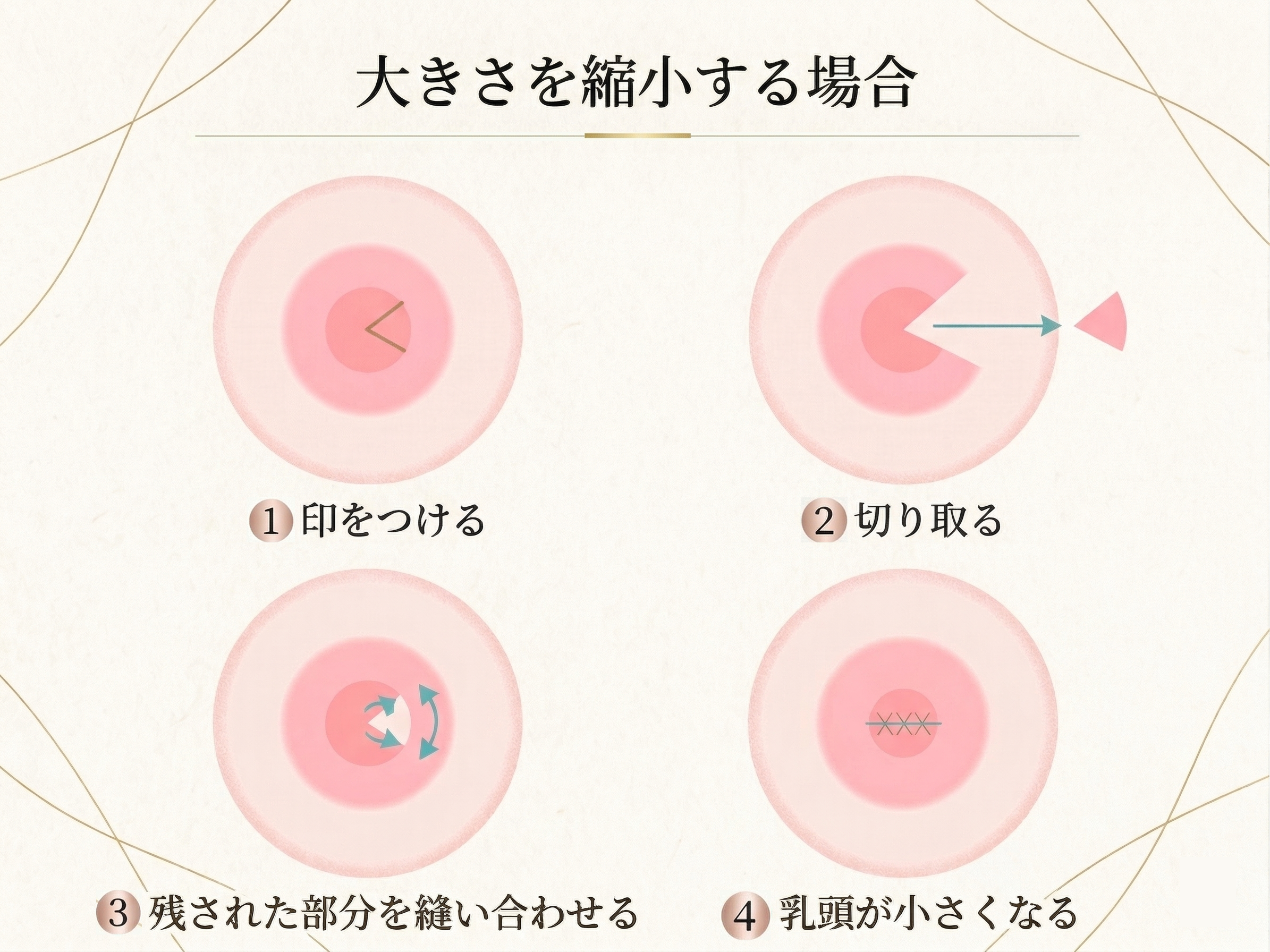 乳頭縮小(横幅)の手術方法解説図