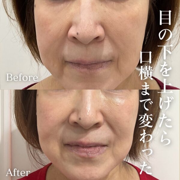 No.21108の症例写真くまりん　4本