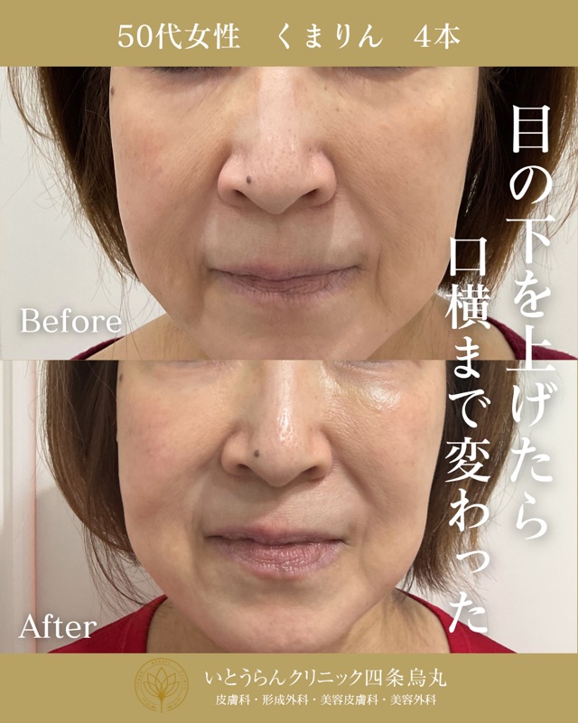 No.21108の症例写真くまりん　4本