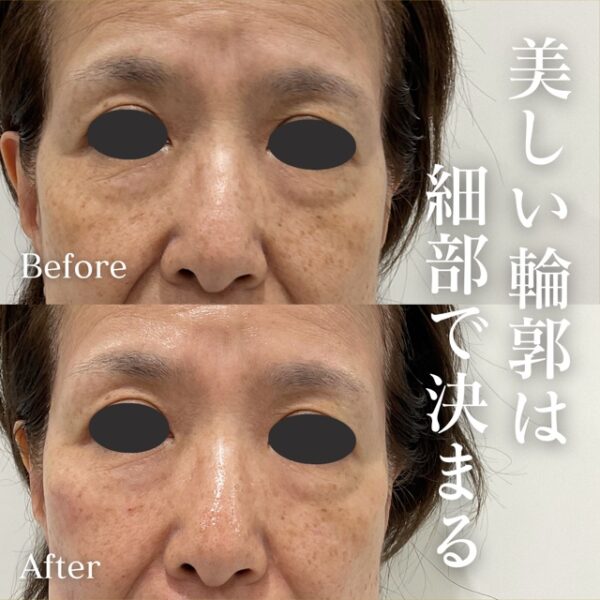 No.21129の症例写真ヒアルロン酸（こめかみ）