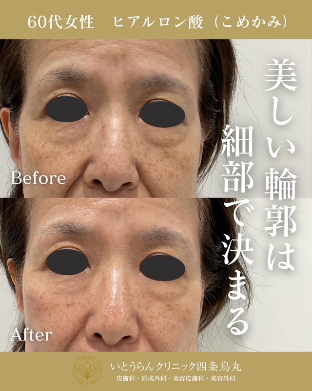 No.21129の症例写真ヒアルロン酸（こめかみ）