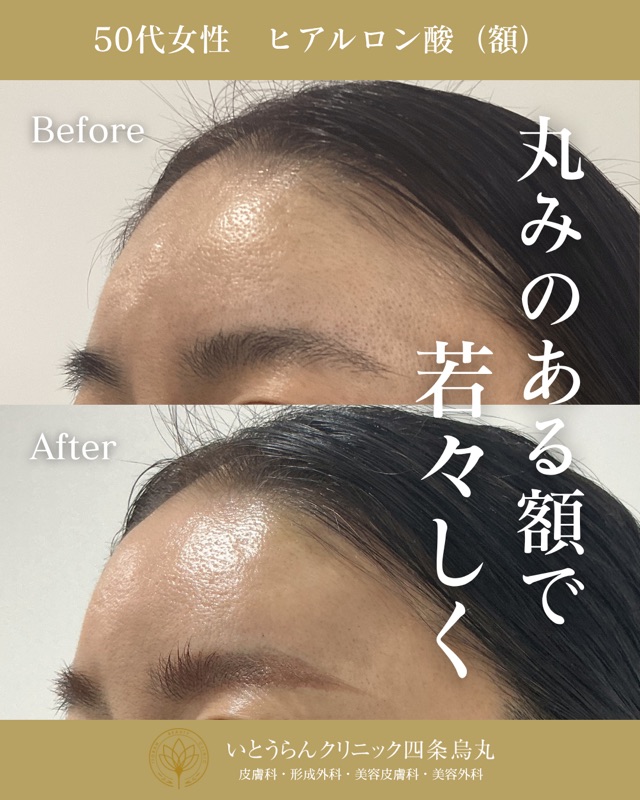 No.21115の症例写真ヒアルロン酸（額）