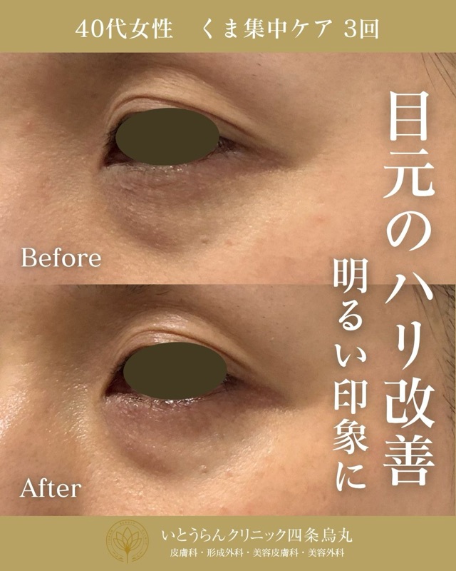 No.21222の症例写真くま集中ケア　3回