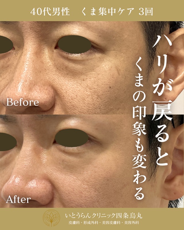 No.21215の症例写真くま集中ケア　3回