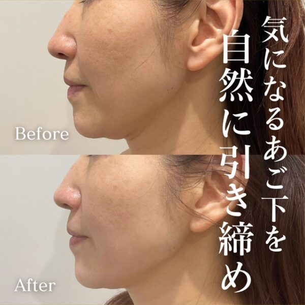 No.21423の症例写真オールタイトリフティング　1回