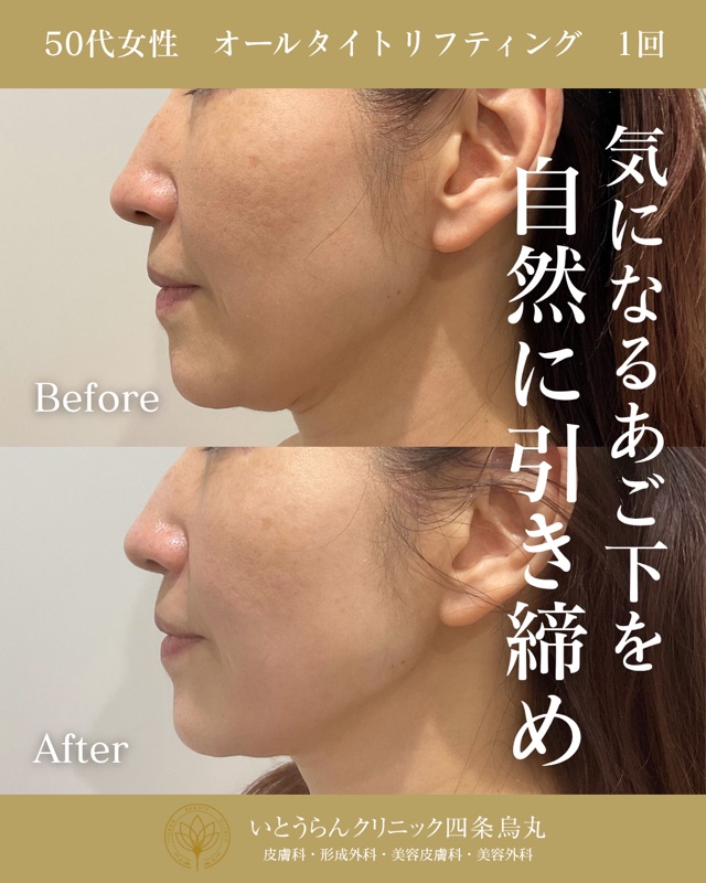 No.21423の症例写真オールタイトリフティング　1回