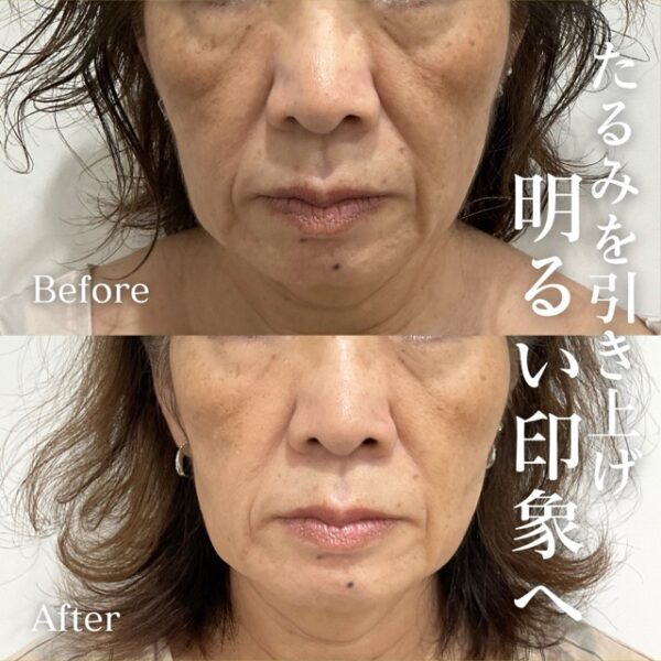 No.21572の症例写真オールタイトリフティング　1回