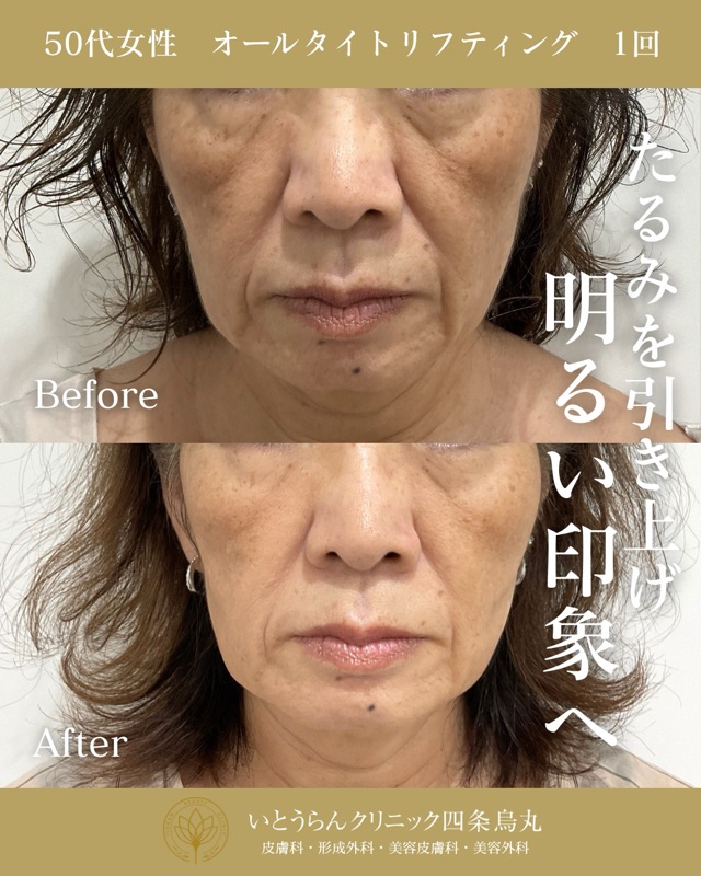 No.21572の症例写真オールタイトリフティング　1回