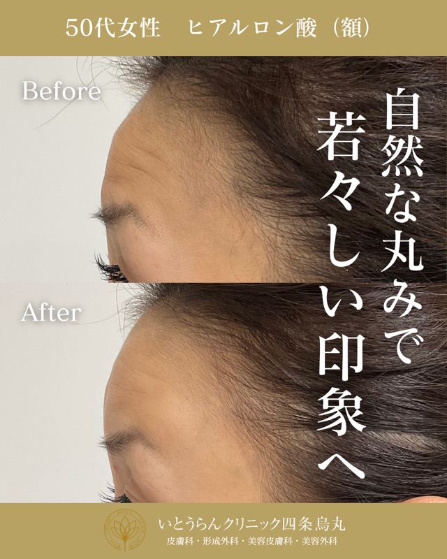 No.21440の症例写真ヒアルロン酸（額）