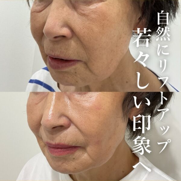 No.21582の症例写真糸リフト　4本