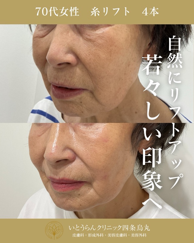 No.21582の症例写真糸リフト　4本