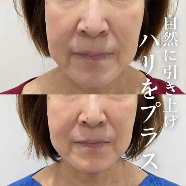 No.21577の症例写真糸リフト　6本