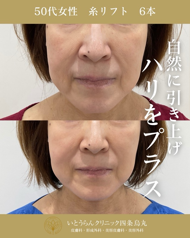No.21577の症例写真糸リフト　6本