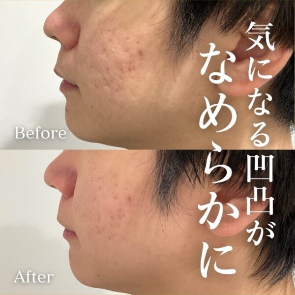 No.22051の症例写真トライフィルプロ（薬剤：ジュベルック）1回