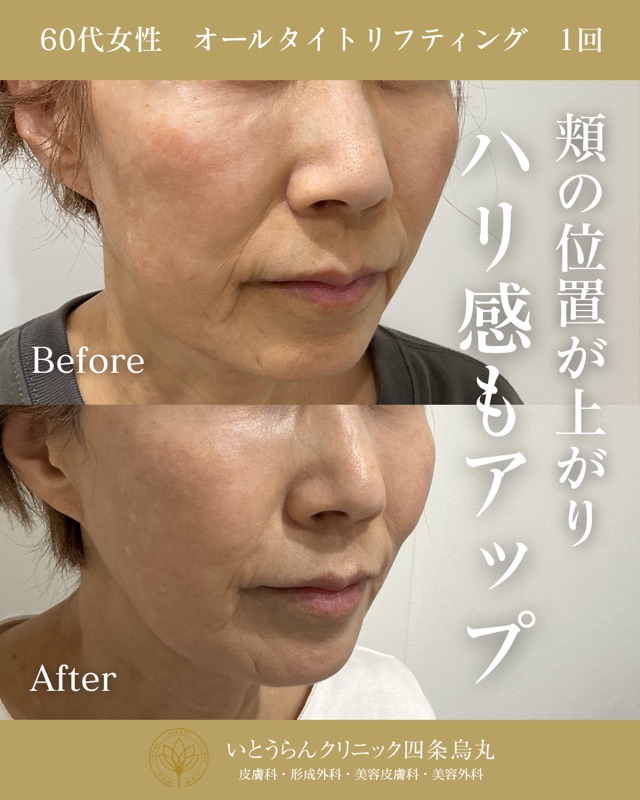 No.21810の症例写真オールタイトリフティング　1回