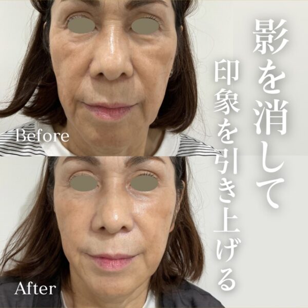 No.21789の症例写真ヒアルロン酸（ほうれい線・こめかみ・マリオネットライン・頬）