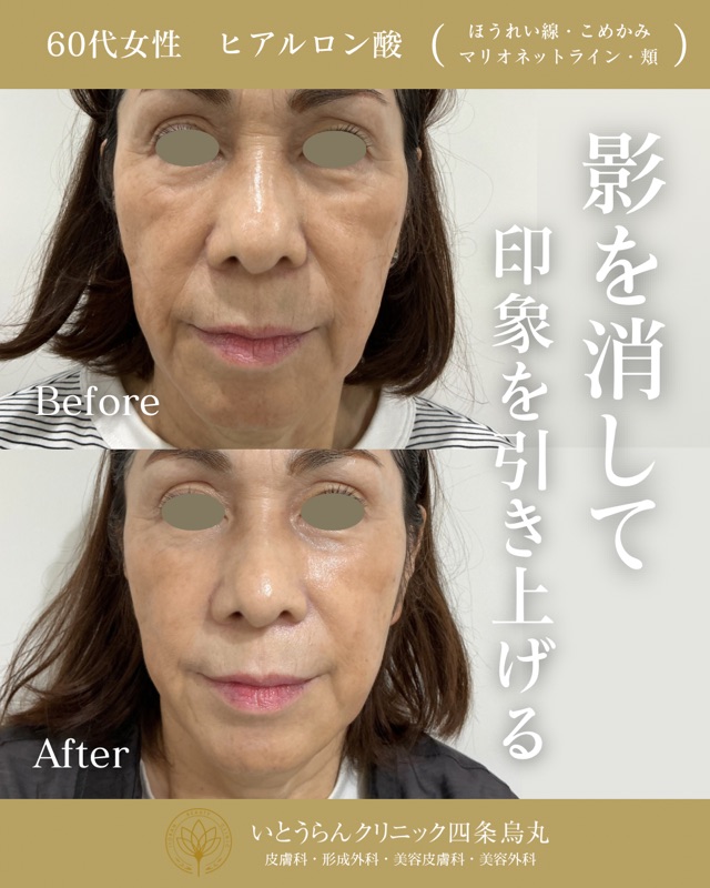 No.21789の症例写真ヒアルロン酸（ほうれい線・こめかみ・マリオネットライン・頬）