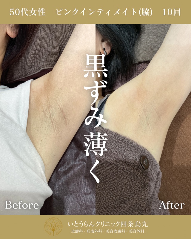 No.21817の症例写真ピンクインティメイト　10回