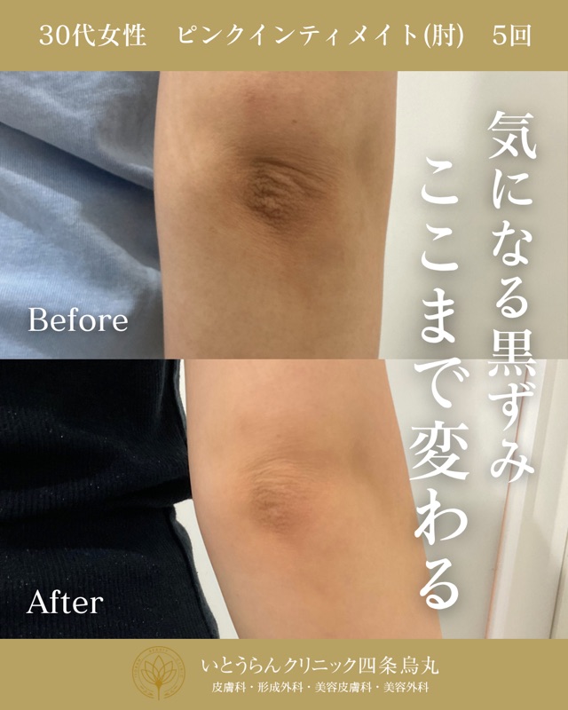 No.21794の症例写真ピンクインティメイト　5回