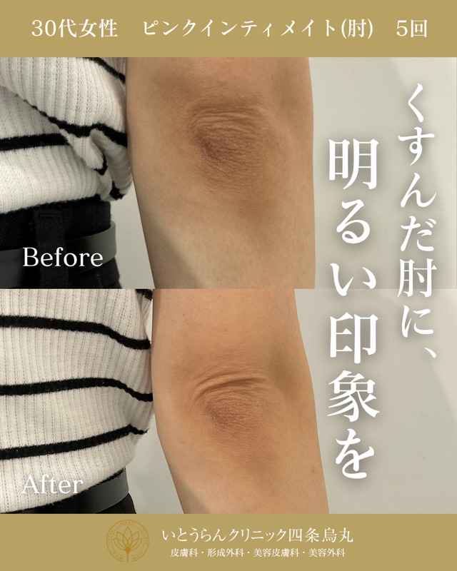 No.22907の症例写真ピンクインティメイト ５回