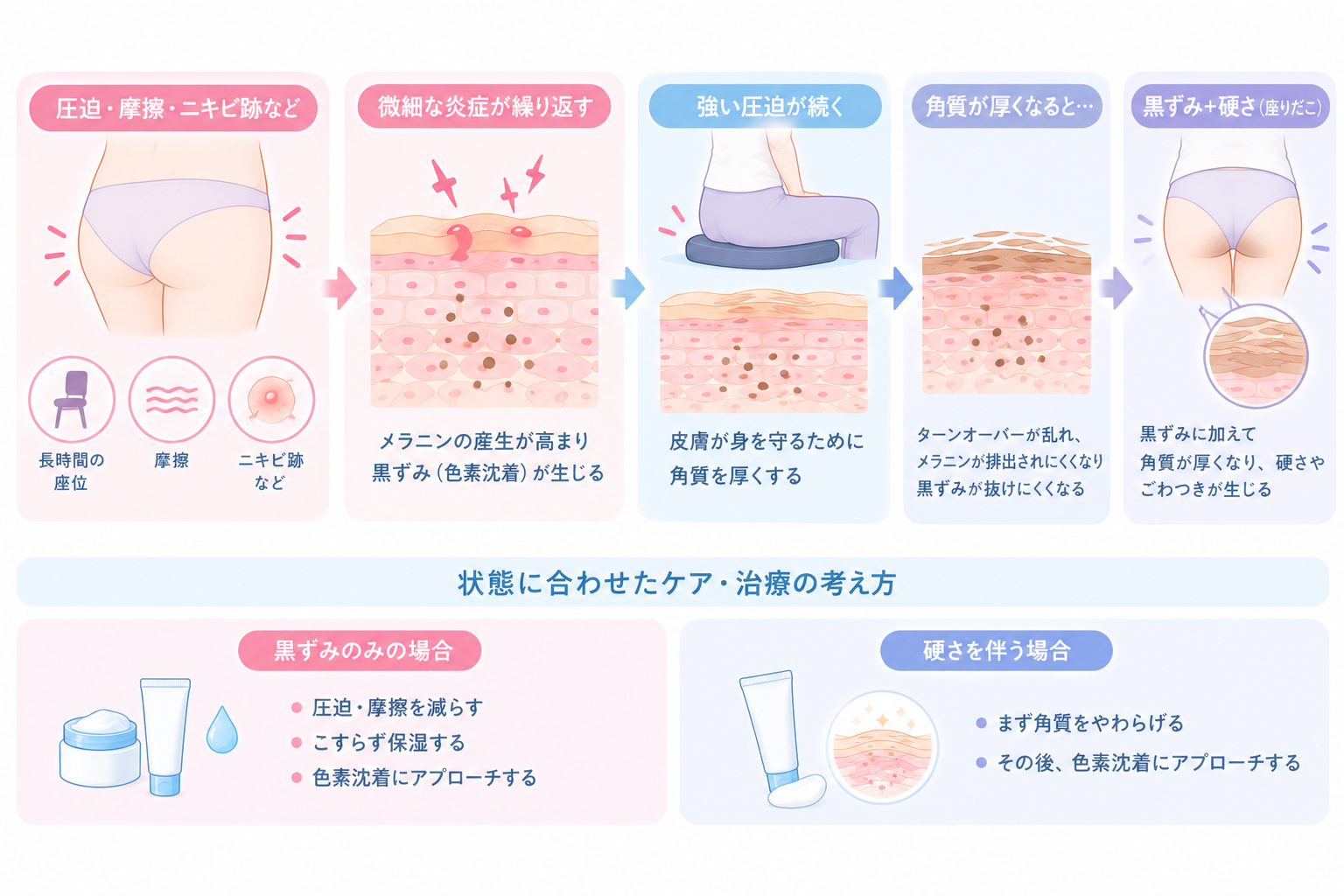 おしりの黒ずみと座りだこ(硬さ)ができる仕組み